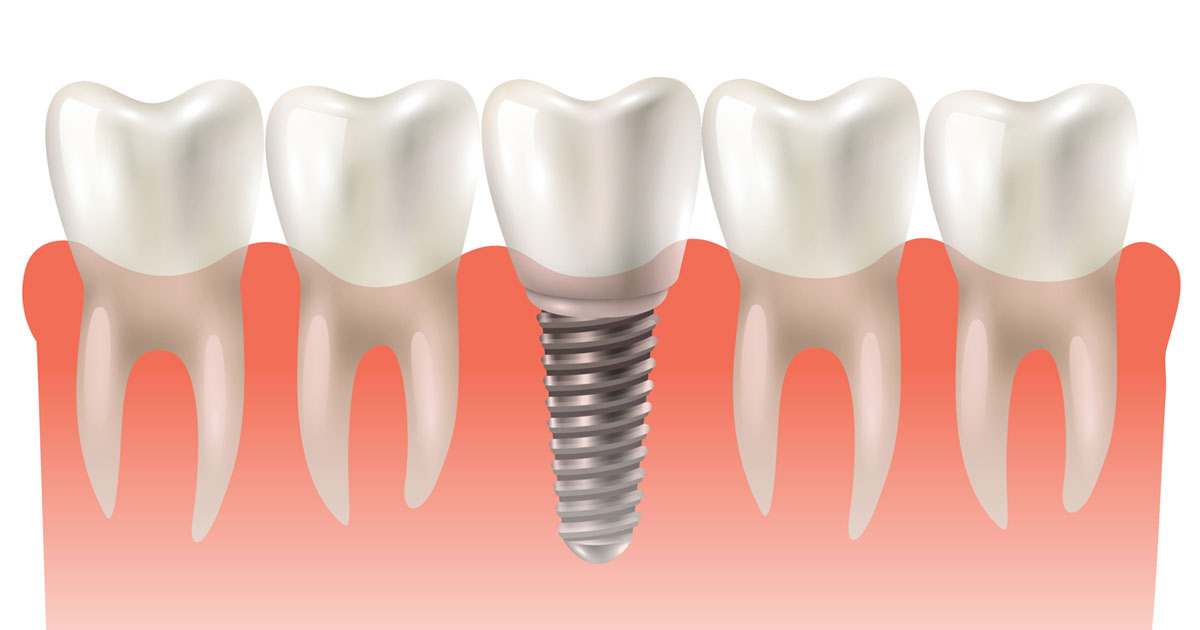Implants | DentPhix Clinics