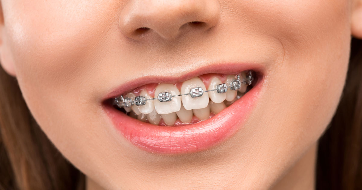 Orthodontics | DentPhix Clinics