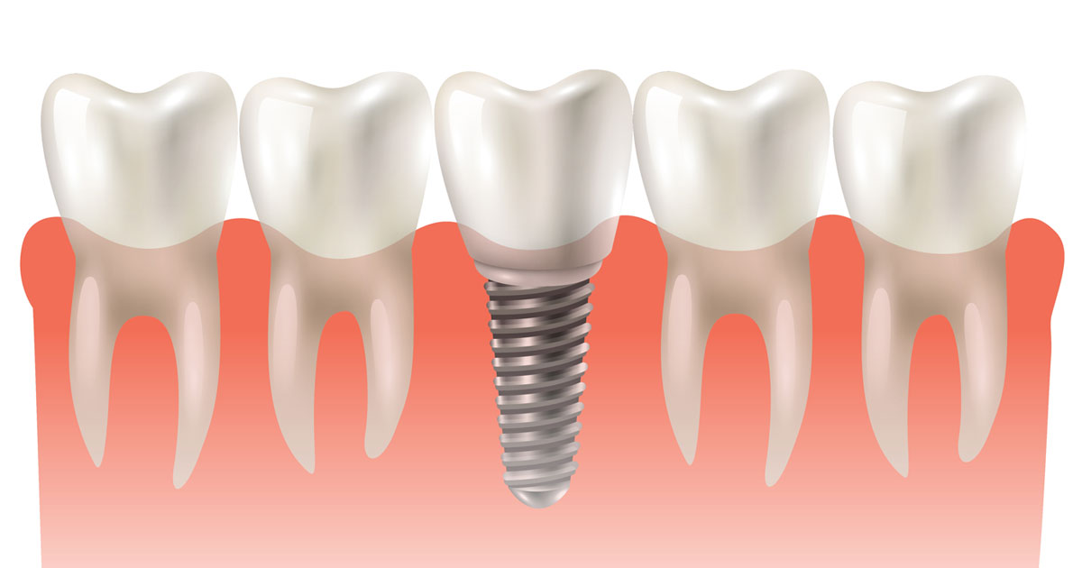 Implants | DentPhix Clinics Implants | DentPhix Clinics
