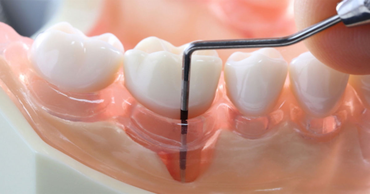 Periodontics | DentPhix Clinics