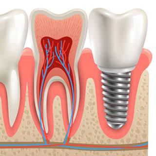 Implants | DentPhix Clinics