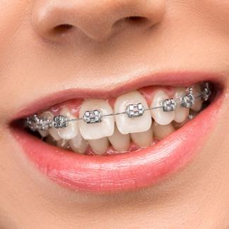 Orthodontics | DentPhix Clinics